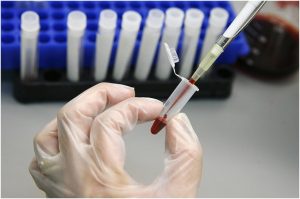 17 новых случаев ВИЧ-инфекции выявлено в Хакасии с начала года